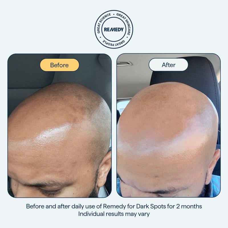 REMEDY for Dark Spots - All-in-One Nightly Serum for Fading Dark Spots & Evening Skin Tone with Retinol, Kojic Acid & Tranexamic Acid